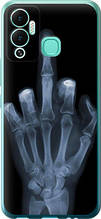 Чохол на Infinix Hot 12 Play Рука через рентген "1007u-2759-851"