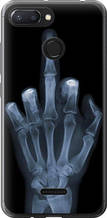 Чохол на Xiaomi Redmi 6 Рука через рентген "1007u-1521-851"