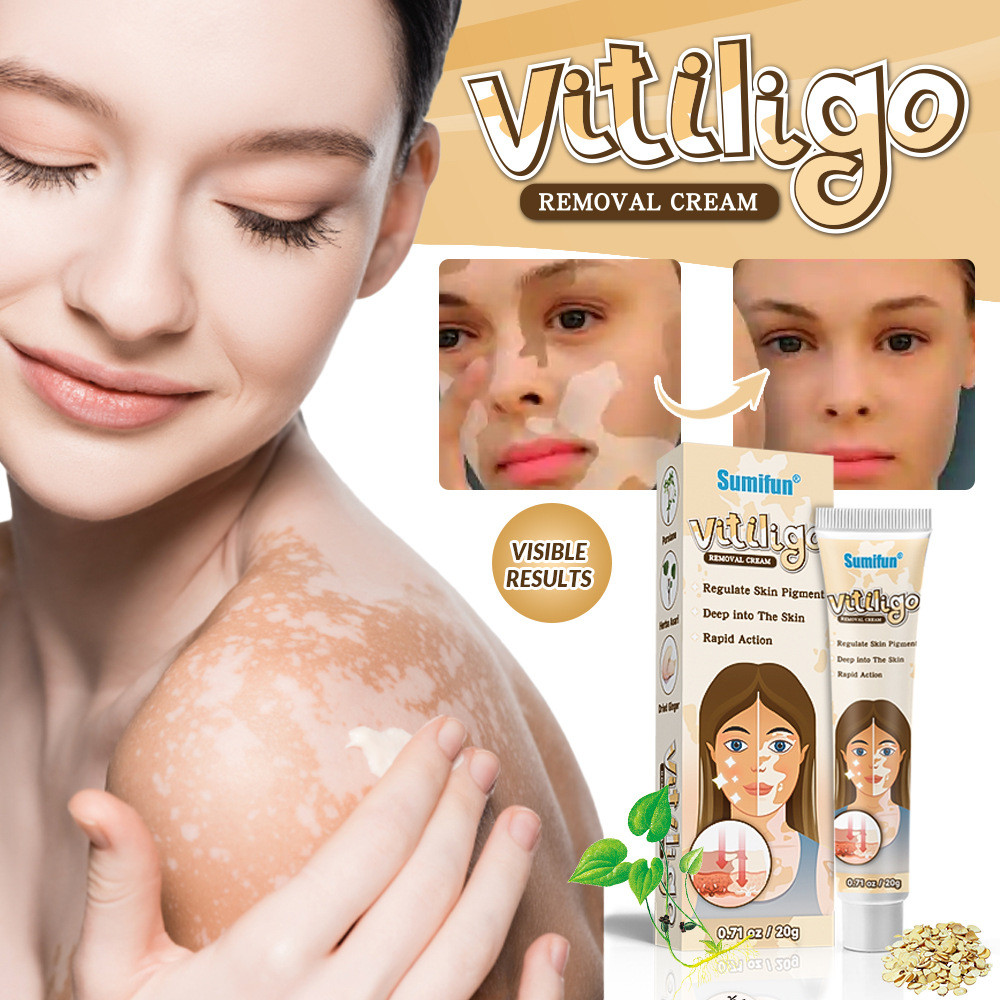 Крем проти вітиліго 20 г. Vitiligo на основі натуральних речовин покращує пігментацію шкіри