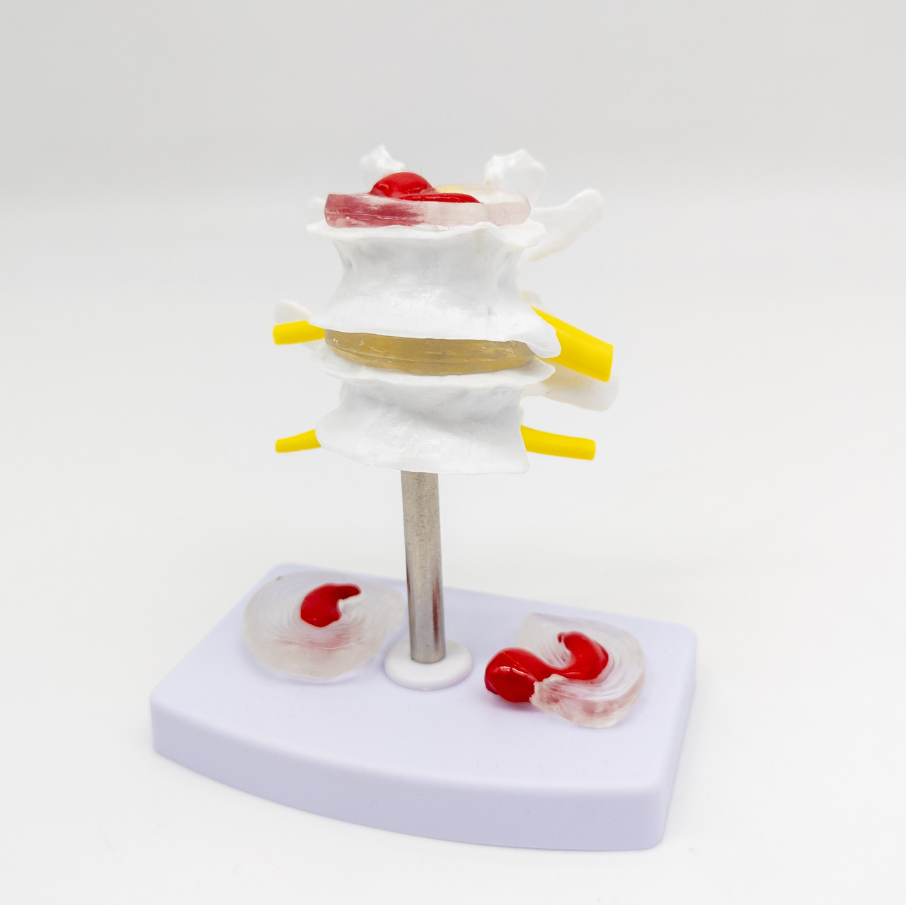 Модель з імітацією грижі міжхребцевого диска фантом