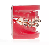 Модель демонстраційна ортодонтична з брекетами, фото 3