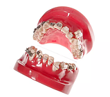 Модель демонстраційна ортодонтична з брекетами, фото 4