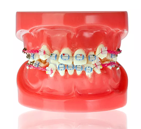 Модель демонстраційна ортодонтична з керамічними брекетами
