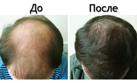 Оригинал!Травяной тоник - эффективное средство против выпадения волос "Ginseng herbal Hair Tonic" (30мл). - фото 4 - id-p461429396