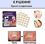 Набір пластирів Elastic Toenail Correction Sticker для корекції врослих нігтів 50 шт, фото 9