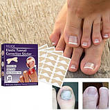 Ефективний набір для корекції врослих нігтів Elastic Toenail Correction Sticker 50 шт, фото 8