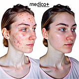 Вакуумний очисник шкіри та пор Medica+ Skincleaner 7.0 (Японія), фото 10
