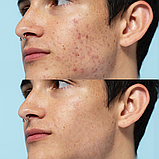 Набір Ультразвуковий скрабер для обличчя MEDICA+ Vibroskin 5.0 + Інструменти для чищення обличчя, фото 9