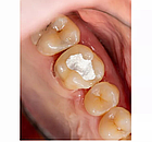 Dengotemp,Тимчасовий пломбувальний матеріал 40 г (Dengen Dental), фото 3