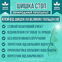 Крем Шишка Стоп 2 флакони засіб від шишок на великих пальцях ніг від болю, фото 3