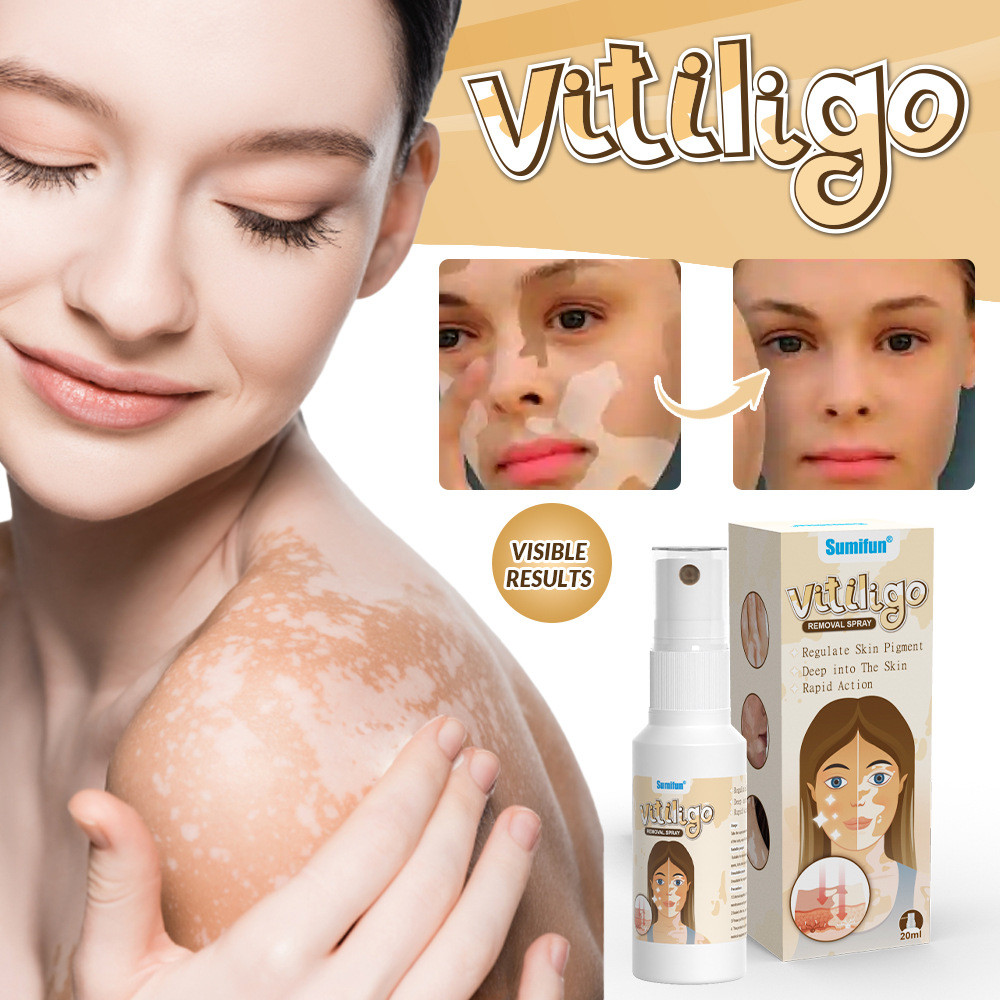 Спрей Трав'яний від Вітиліго (Treatment ointment Vitiligo Sumifun) 20 г Китай, білі плями, фото 1
