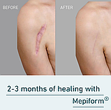 Мепіформ Molnlycke Mepiform 4x30см 5 шт. силіконовий пластир для лікування рубців, фото 7