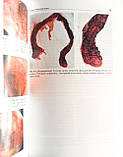 Семенкін, Огорыльців Атлас колопроктологічних захворювань, фото 3