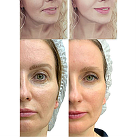 Мікрострумовий RF Lifting Масажер для обличчя Skin Lifting 7.0 White - EMS, LED, фото 7