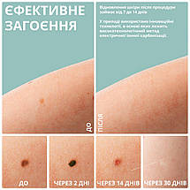 Електрокоагулятор Swan Beauty Y-3.0 для видалення папілом та бородавок плазмова ручка біла, фото 6