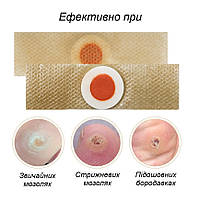 Пластир для видалення мозолів, сухих мозолів та натоптишів 1 пластина 6 шт, фото 4