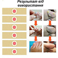 Пластир для видалення мозолів, сухих мозолів та натоптишів 1 пластина 6 шт, фото 7