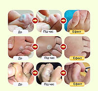 Пластир для видалення мозолів, сухих мозолів та натоптишів 1 пластина 6 шт, фото 8