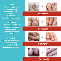 Пластырь-наклейки для коррекции вросшего ногтя Nail Patches в упаковке 16 шт, фото 3