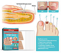 Пластырь-наклейки для коррекции вросшего ногтя Nail Patches в упаковке 16 шт, фото 9