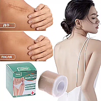 Силіконовий пластир від шрамів і рубців після операцій, кесаревого, опіках, водостійкий, гіпоалергенний 4×150 см, фото 6