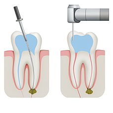 Сучасні ендодонтичні інструменти