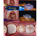 Dengen Supreme,Наногібридний композитний матеріал (Dengen Dental), фото 4