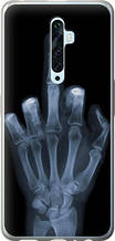 Чохол на Oppo Reno 2Z Рука через рентген "1007u-1867-851"