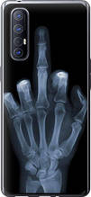 Чохол на Oppo Reno 3 Pro Рука через рентген "1007u-1878-851"