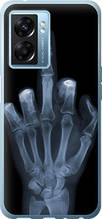 Чохол на Oppo A77 5G Рука через рентген "1007u-1377-851"