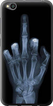 Чохол на Xiaomi Redmi Go Рука через рентген "1007u-1667-851"