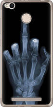 Чохол на Xiaomi Redmi 3x Рука через рентген "1007u-441-851"
