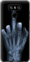 Чохол на LG G6 Рука через рентген "1007u-836-851"