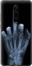 Чохол на Xiaomi Mi 9T Pro Рука через рентген "1007u-1698-851"