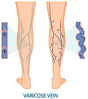Як допомогти своїм венам, якщо весь день на ногах?