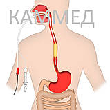 Дилататор стравоходу., фото 3