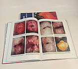 Жирарди Ф. Кольпоскопія і патологія шийки матки по Бургхардту посібник-атлас по кольпоскопії, фото 6