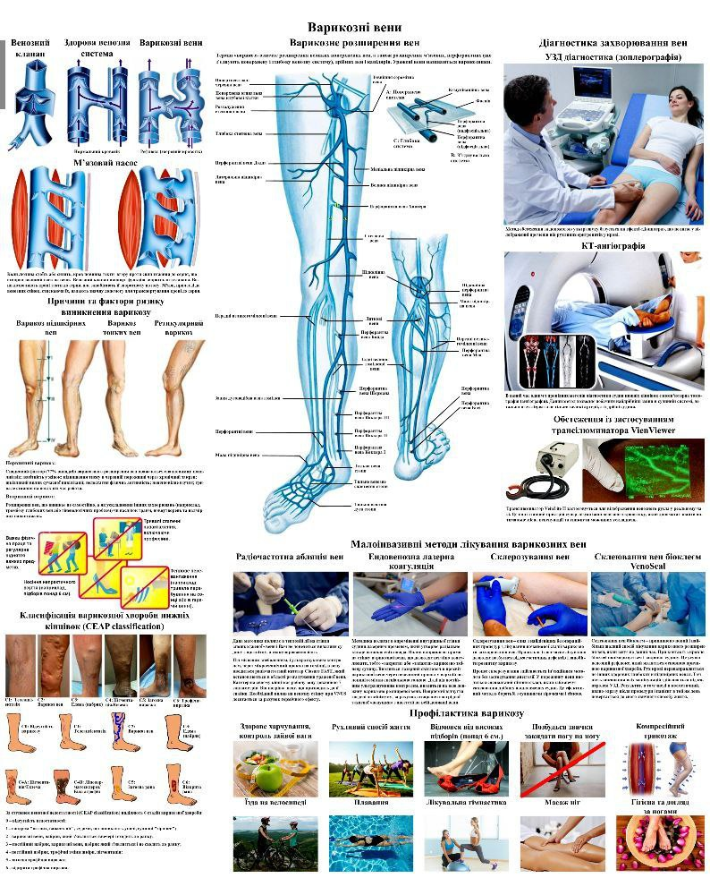 Плакат Варикозні вени 67 х 86 см Демонстраційний матеріал для медичного кабінету, фото 1