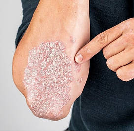 Кошти від псоріазу