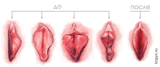 Роды  вагина 