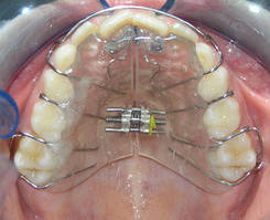 Знімний ортодонтичний апарат