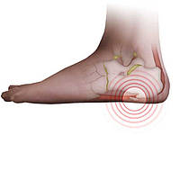 П'яткова шпора – основні причини появи й способи лікування