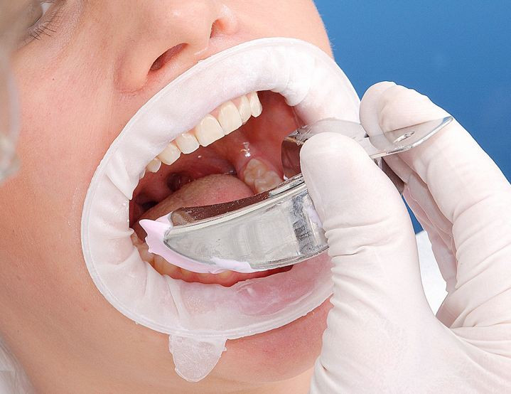 OptraGate (Оптрагейт) ретрактор губ и щек размер Small: продажа, цена в ...