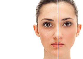 Skin Type, Hyperpigmentation, Sun Damaged Skin