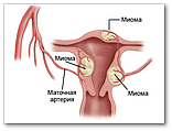 Міома матки й аденоміоз. Кафедра акушерства і гінекології ФППОВ ММА їм. І. М. Сеченова