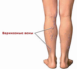 Не хочу я синих ног…