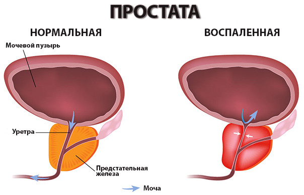 Схема простати.Малюнок 1.