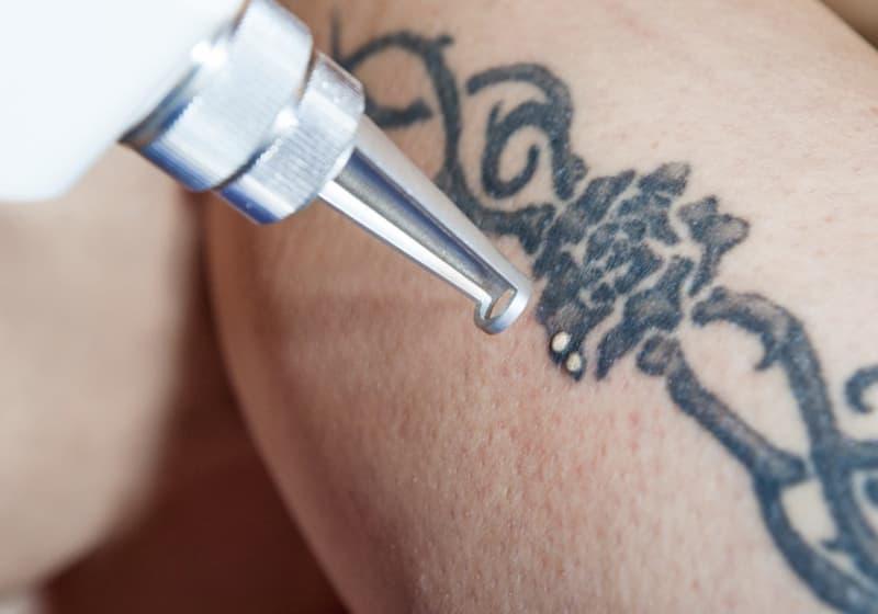 Лазерне видалення татуювань  і перманента