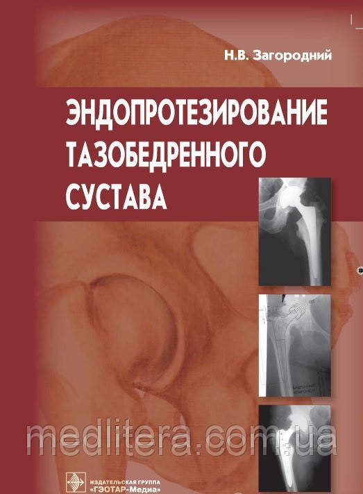 Загородній Н.В. Ендопротезування кульшового суглоба
