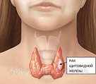 Рак щитовидної залози